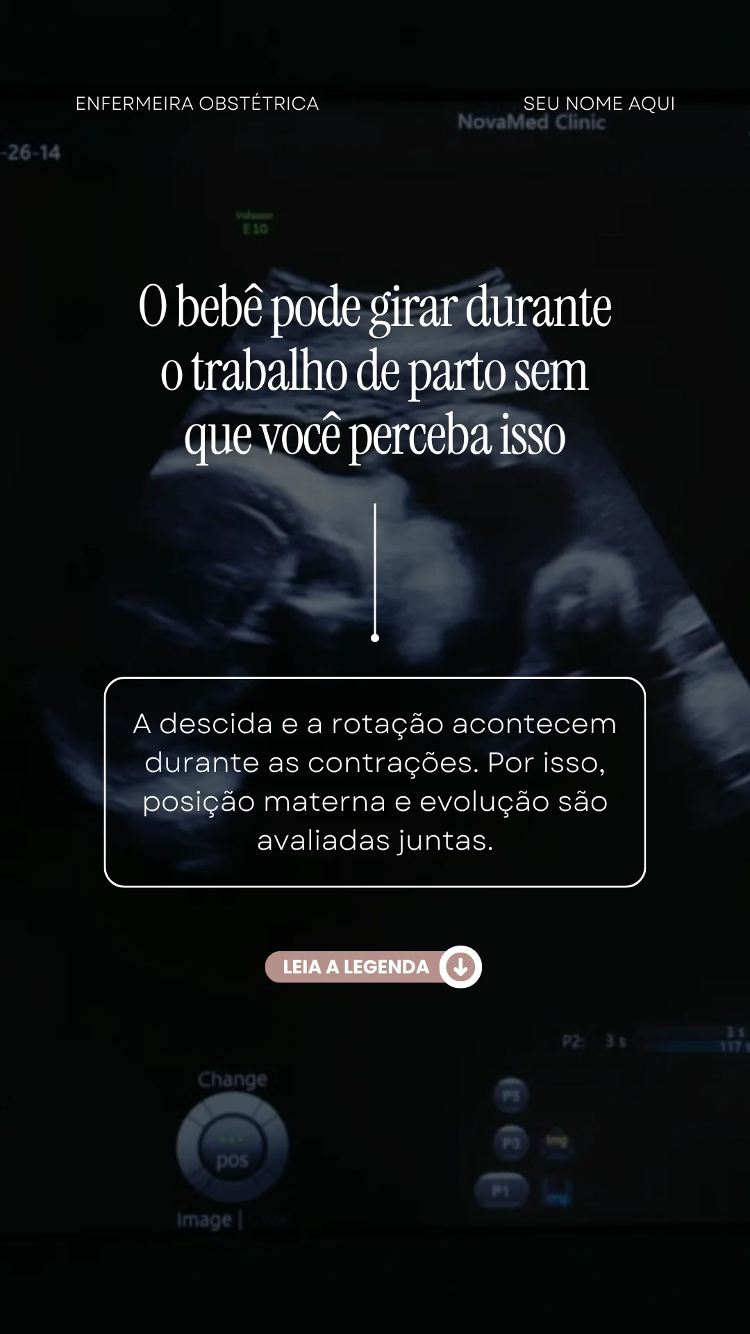 Prévia do Pack de Reels Enfermagem Obstétrica 5
